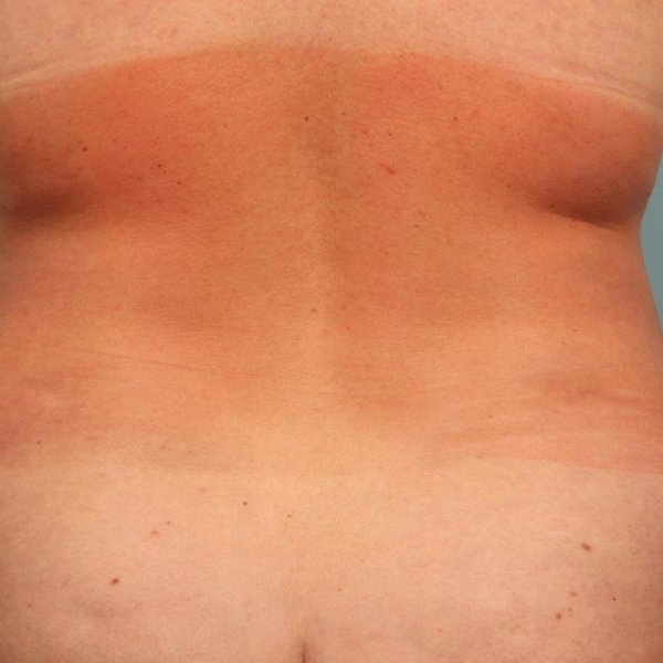 Liposuction