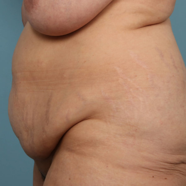 Tummy Tuck & Gastric Sleeve